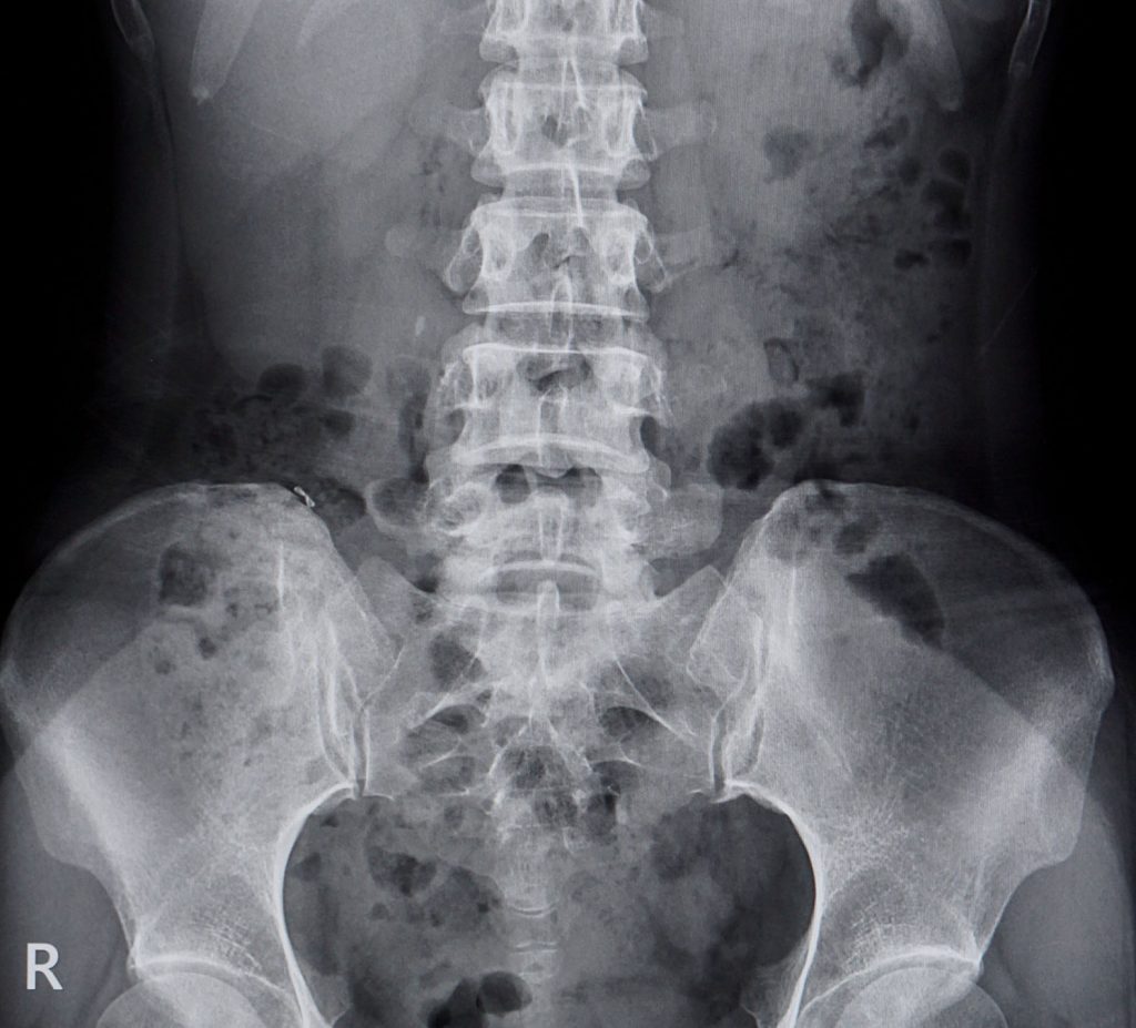 X-rays